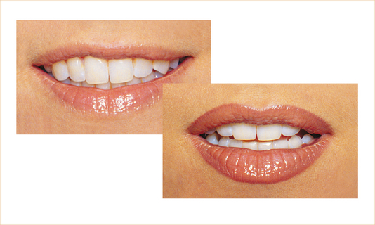 Lippen01_FACE_TUNE_vorher-nachher