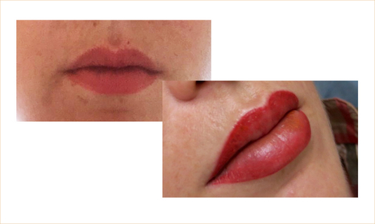 Lippen02_FACE_TUNE_vorher-nachher