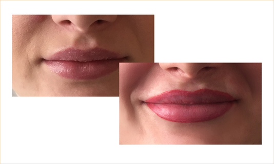 Lippen03_FACE_TUNE_vorher-nachher